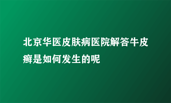 北京华医皮肤病医院解答牛皮癣是如何发生的呢