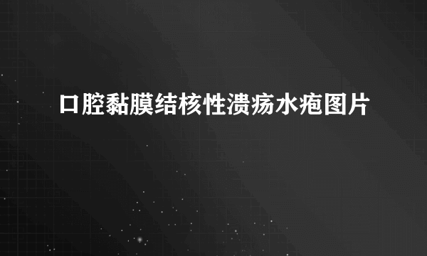 口腔黏膜结核性溃疡水疱图片