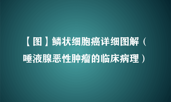 【图】鳞状细胞癌详细图解（唾液腺恶性肿瘤的临床病理）