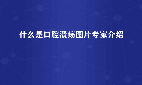 什么是口腔溃疡图片专家介绍