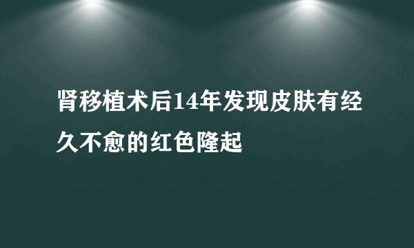 肾移植术后14年发现皮肤有经久不愈的红色隆起