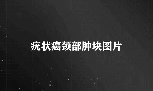 疣状癌颈部肿块图片