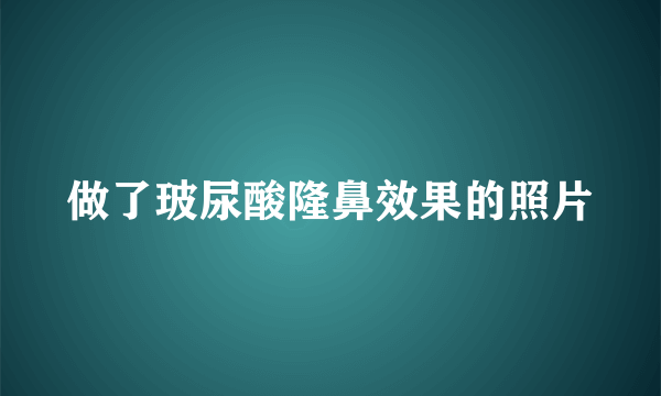 做了玻尿酸隆鼻效果的照片