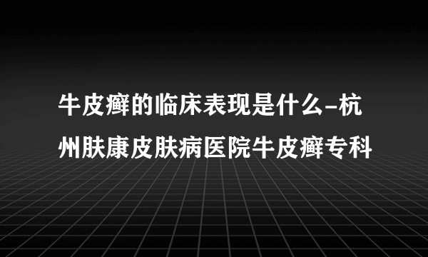 牛皮癣的临床表现是什么-杭州肤康皮肤病医院牛皮癣专科