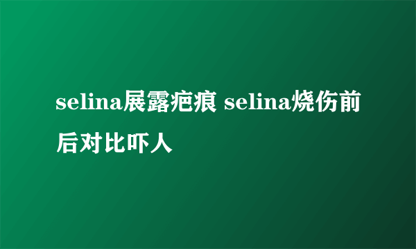 selina展露疤痕 selina烧伤前后对比吓人