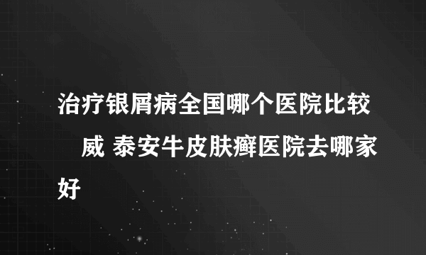 治疗银屑病全国哪个医院比较權威 泰安牛皮肤癣医院去哪家好