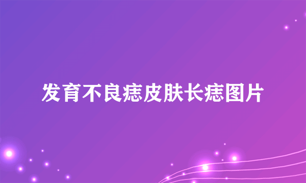 发育不良痣皮肤长痣图片