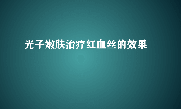 光子嫩肤治疗红血丝的效果 