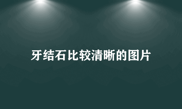 牙结石比较清晰的图片